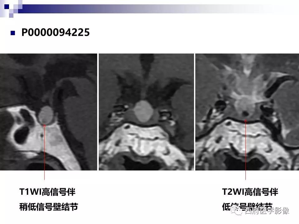 影像PPT - 【PPT】垂体囊性病变回顾性讨论-31
