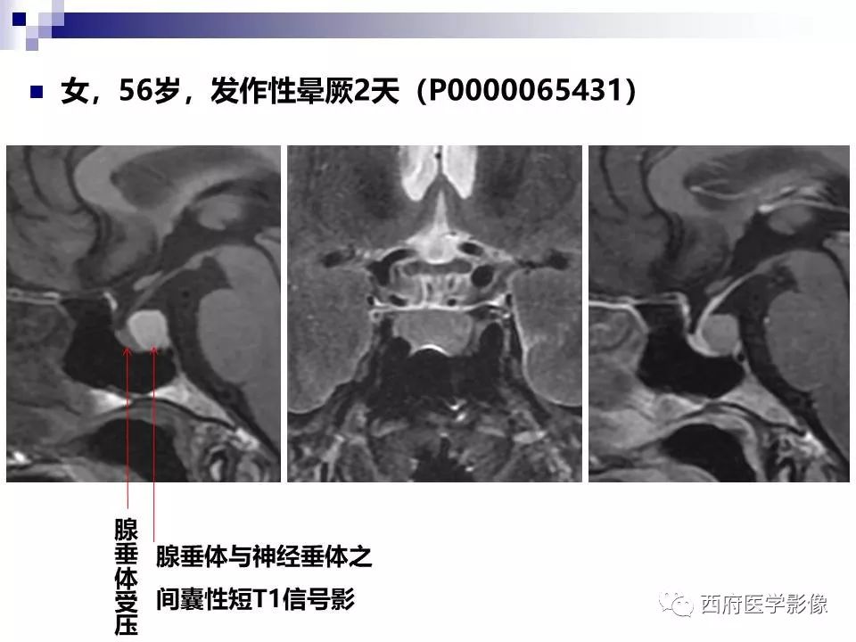 影像PPT - 【PPT】垂体囊性病变回顾性讨论-32