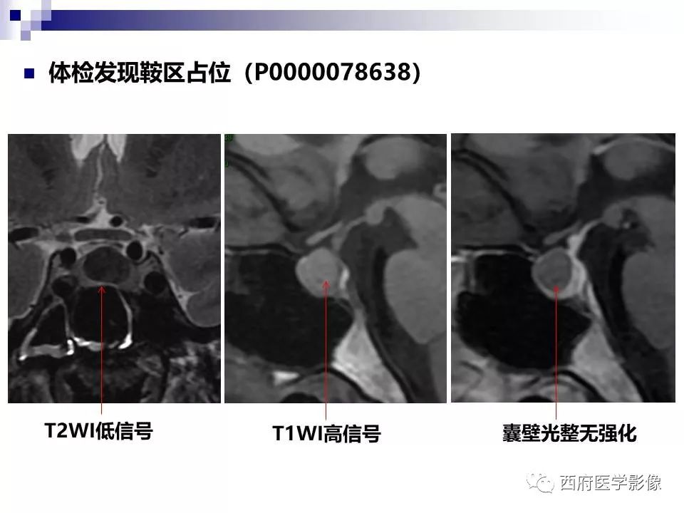 影像PPT - 【PPT】垂体囊性病变回顾性讨论-34