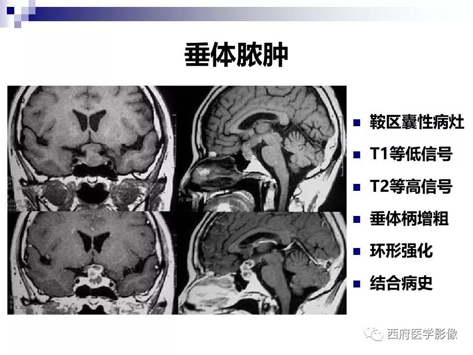 影像PPT - 【PPT】垂体囊性病变回顾性讨论-39