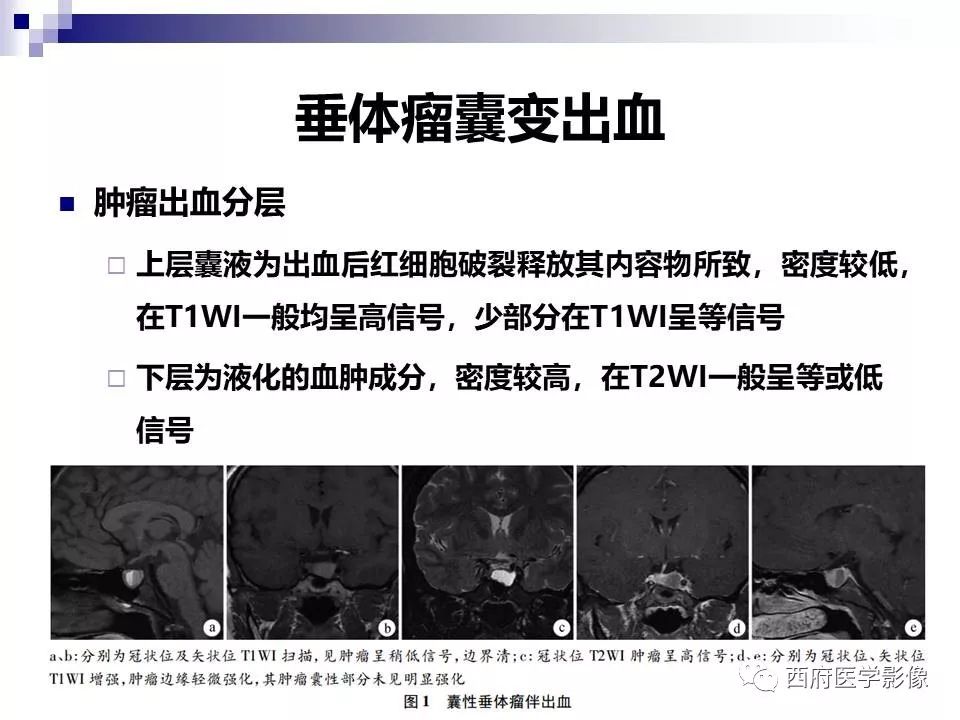 影像PPT - 【PPT】垂体囊性病变回顾性讨论-43