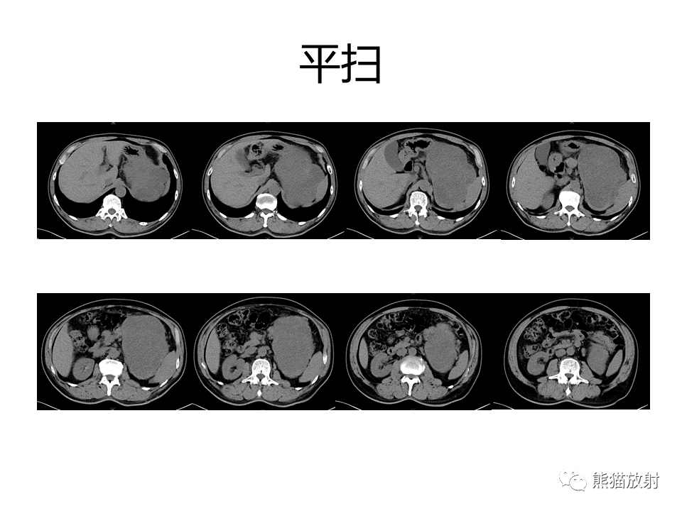 影像PPT - 【PPT】胃肠道间质瘤GIST VS 胃平滑肌瘤-4