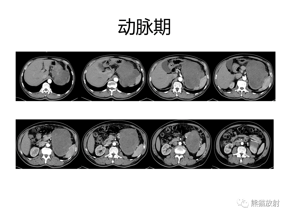 影像PPT - 【PPT】胃肠道间质瘤GIST VS 胃平滑肌瘤-5