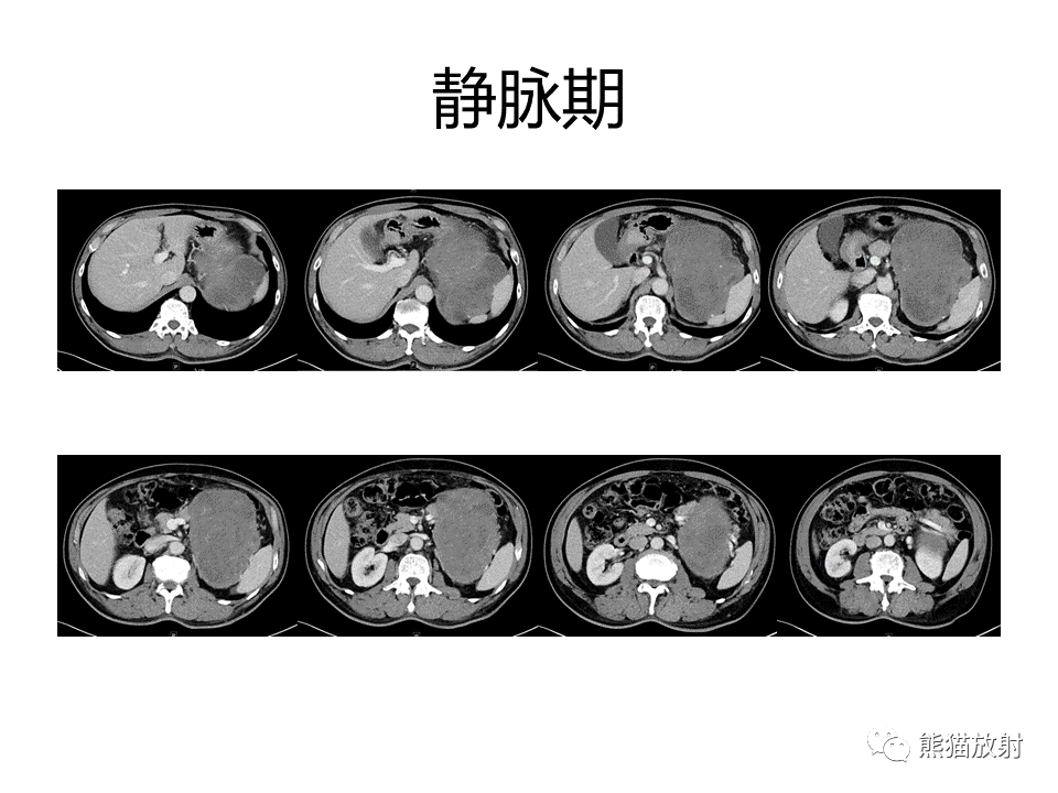 影像PPT - 【PPT】胃肠道间质瘤GIST VS 胃平滑肌瘤-6