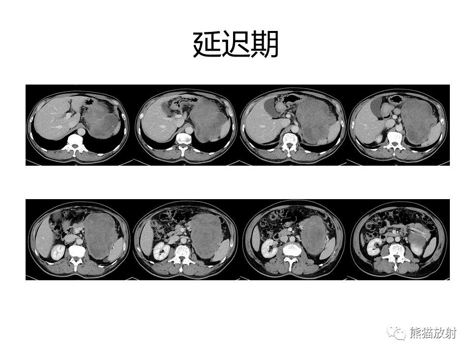 影像PPT - 【PPT】胃肠道间质瘤GIST VS 胃平滑肌瘤-7