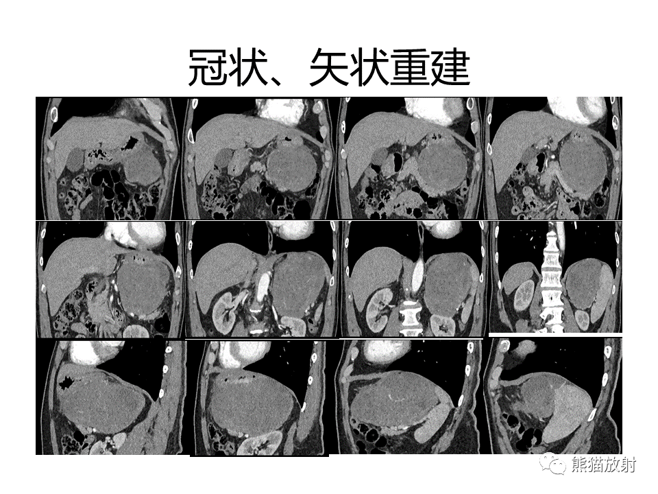 影像PPT - 【PPT】胃肠道间质瘤GIST VS 胃平滑肌瘤-8