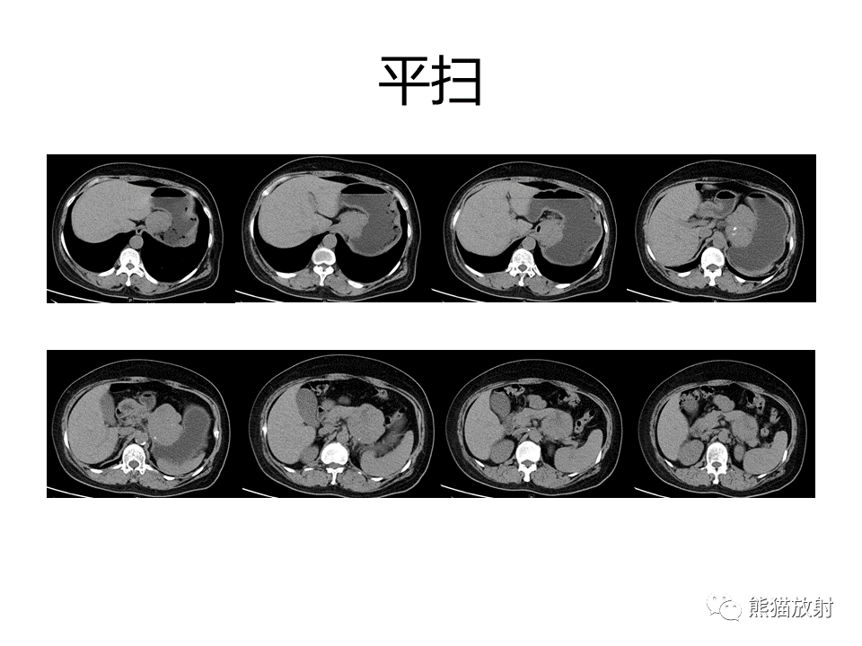 影像PPT - 【PPT】胃肠道间质瘤GIST VS 胃平滑肌瘤-12