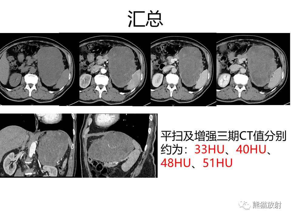影像PPT - 【PPT】胃肠道间质瘤GIST VS 胃平滑肌瘤-9
