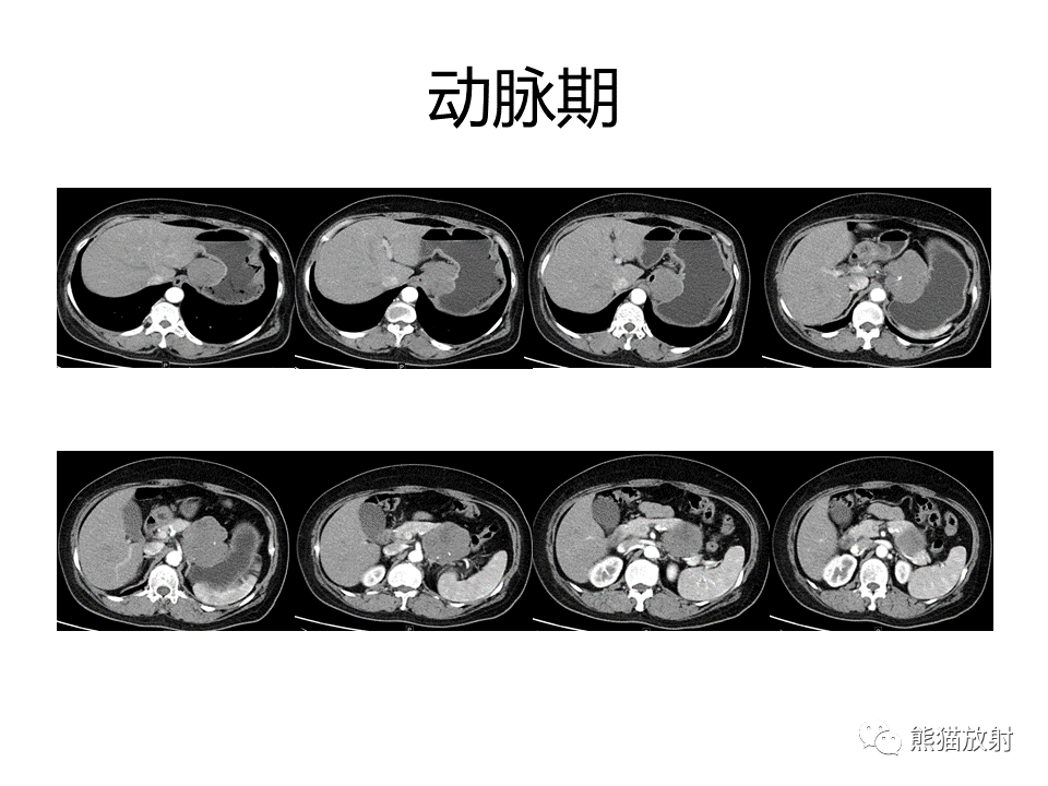 影像PPT - 【PPT】胃肠道间质瘤GIST VS 胃平滑肌瘤-13