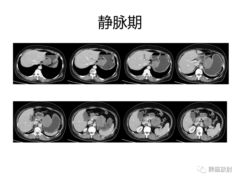 影像PPT - 【PPT】胃肠道间质瘤GIST VS 胃平滑肌瘤-14