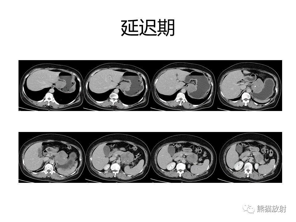 影像PPT - 【PPT】胃肠道间质瘤GIST VS 胃平滑肌瘤-15