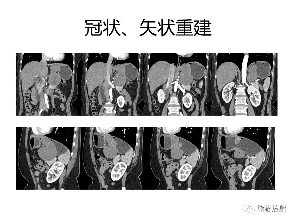 影像PPT - 【PPT】胃肠道间质瘤GIST VS 胃平滑肌瘤-16