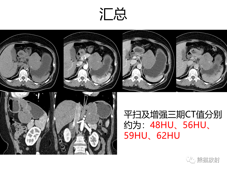 影像PPT - 【PPT】胃肠道间质瘤GIST VS 胃平滑肌瘤-17