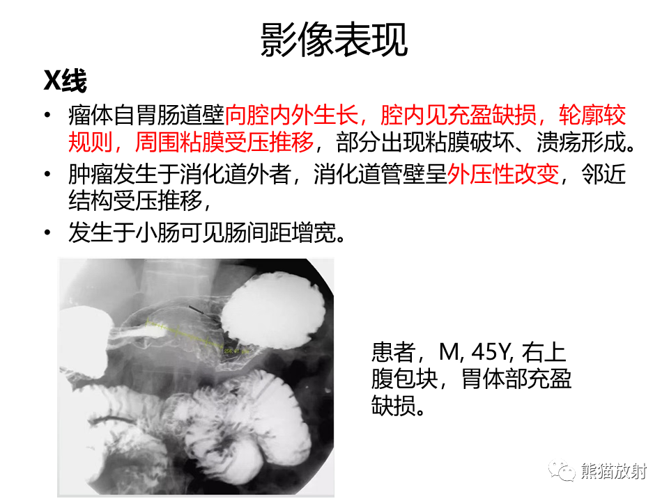 影像PPT - 【PPT】胃肠道间质瘤GIST VS 胃平滑肌瘤-27
