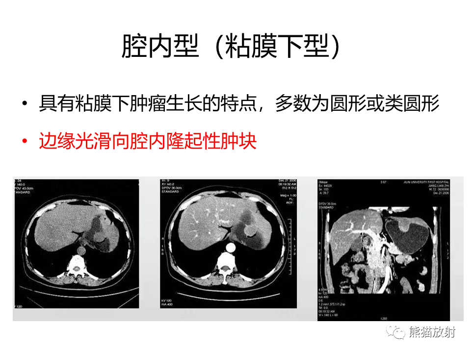 影像PPT - 【PPT】胃肠道间质瘤GIST VS 胃平滑肌瘤-30