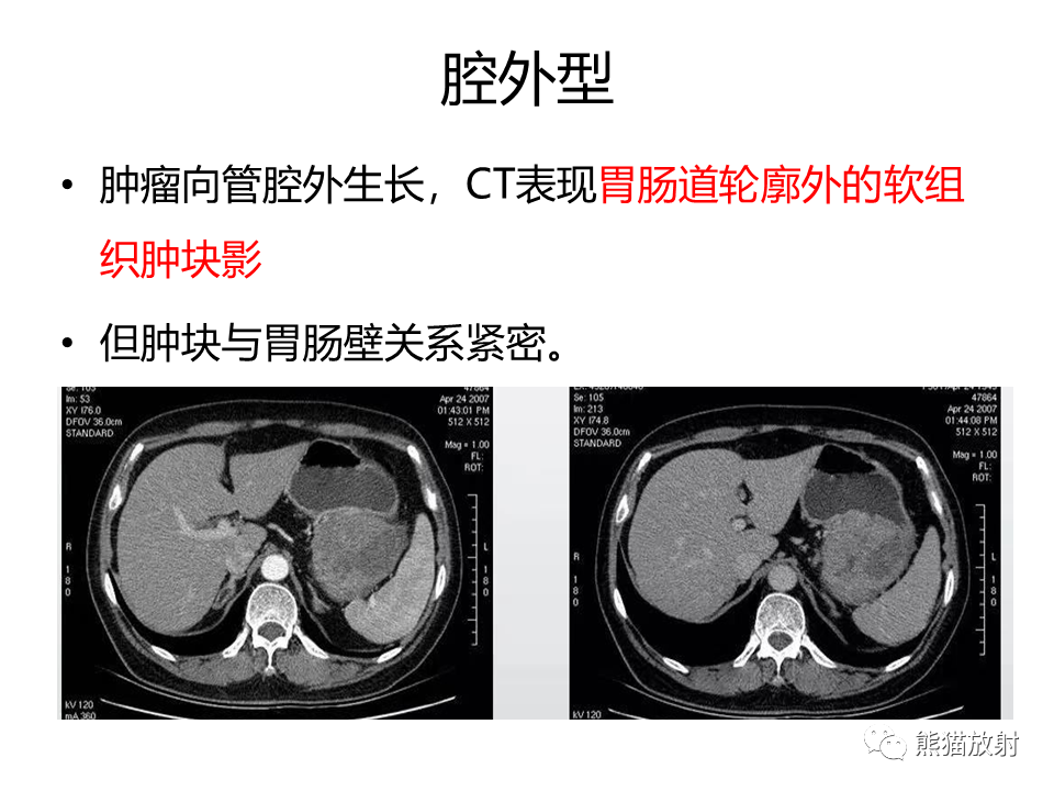 影像PPT - 【PPT】胃肠道间质瘤GIST VS 胃平滑肌瘤-31