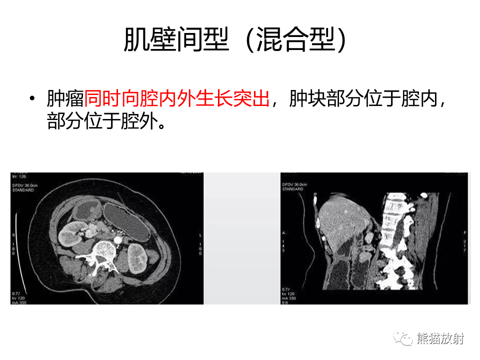 影像PPT - 【PPT】胃肠道间质瘤GIST VS 胃平滑肌瘤-32