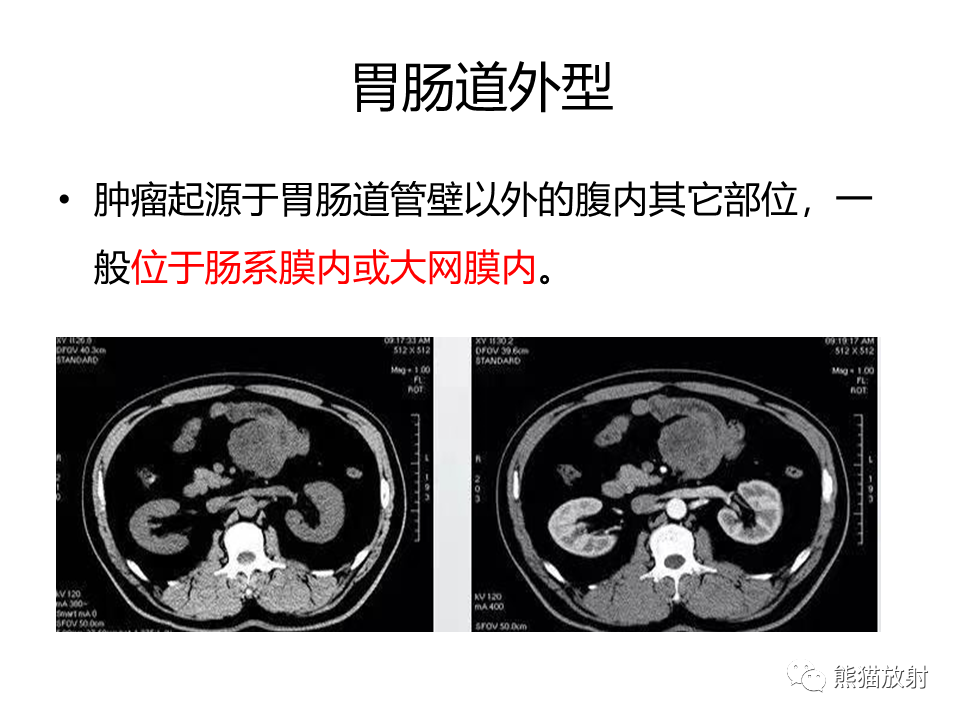 影像PPT - 【PPT】胃肠道间质瘤GIST VS 胃平滑肌瘤-33