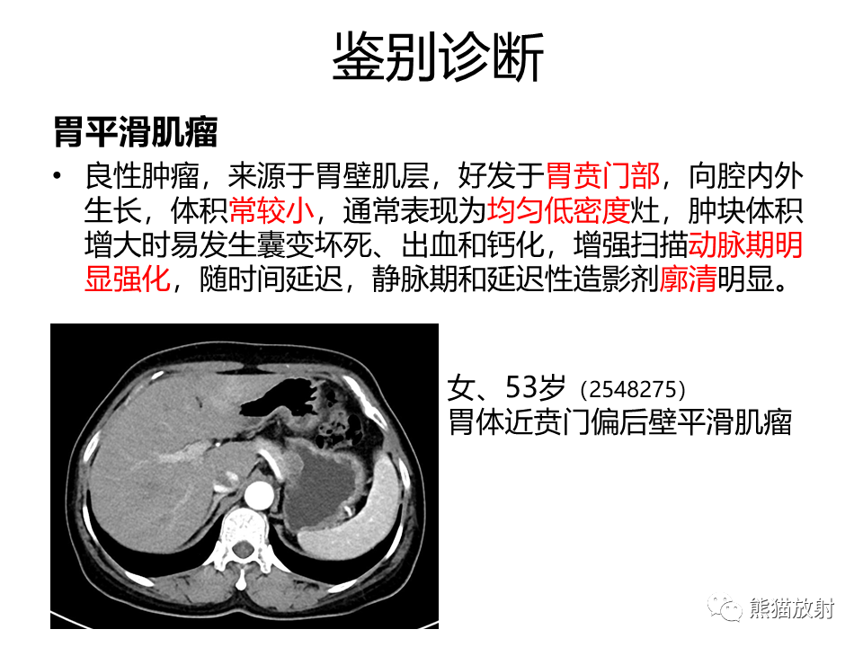影像PPT - 【PPT】胃肠道间质瘤GIST VS 胃平滑肌瘤-37