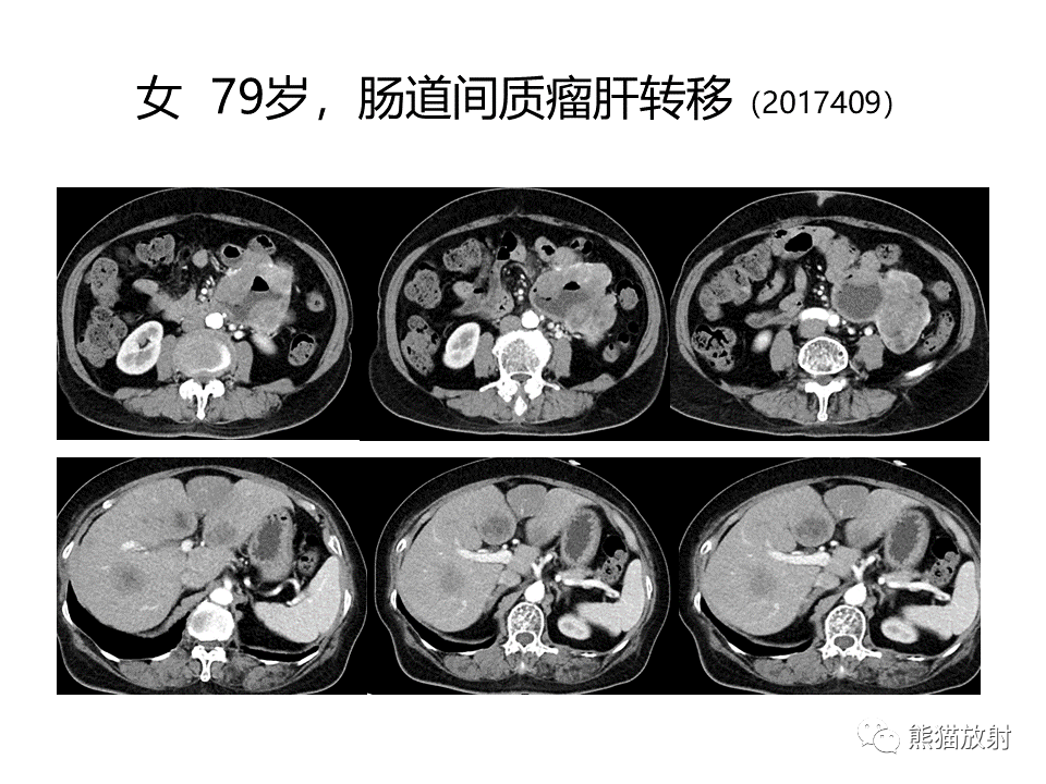 影像PPT - 【PPT】胃肠道间质瘤GIST VS 胃平滑肌瘤-36