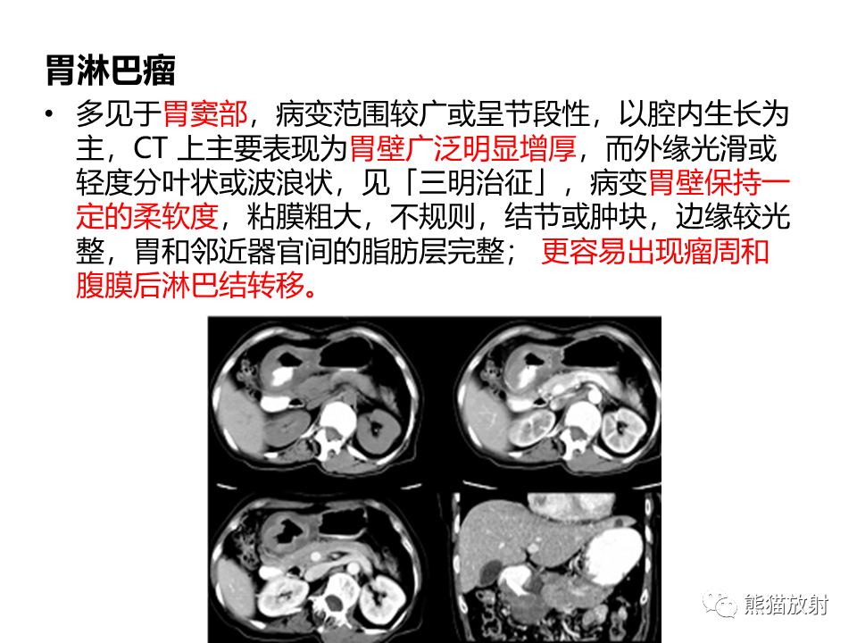 影像PPT - 【PPT】胃肠道间质瘤GIST VS 胃平滑肌瘤-38