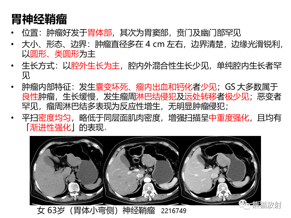 影像PPT - 【PPT】胃肠道间质瘤GIST VS 胃平滑肌瘤-39