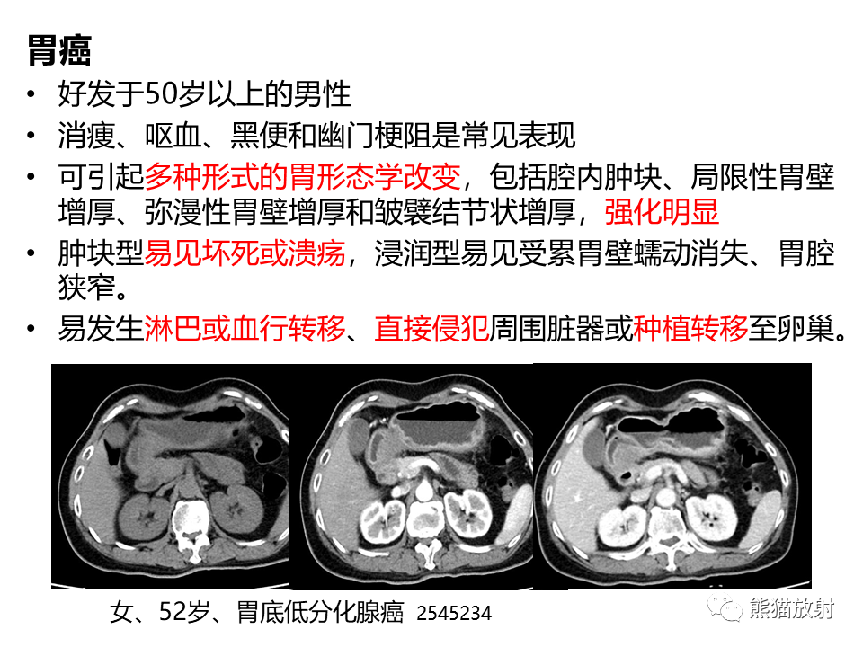 影像PPT - 【PPT】胃肠道间质瘤GIST VS 胃平滑肌瘤-40