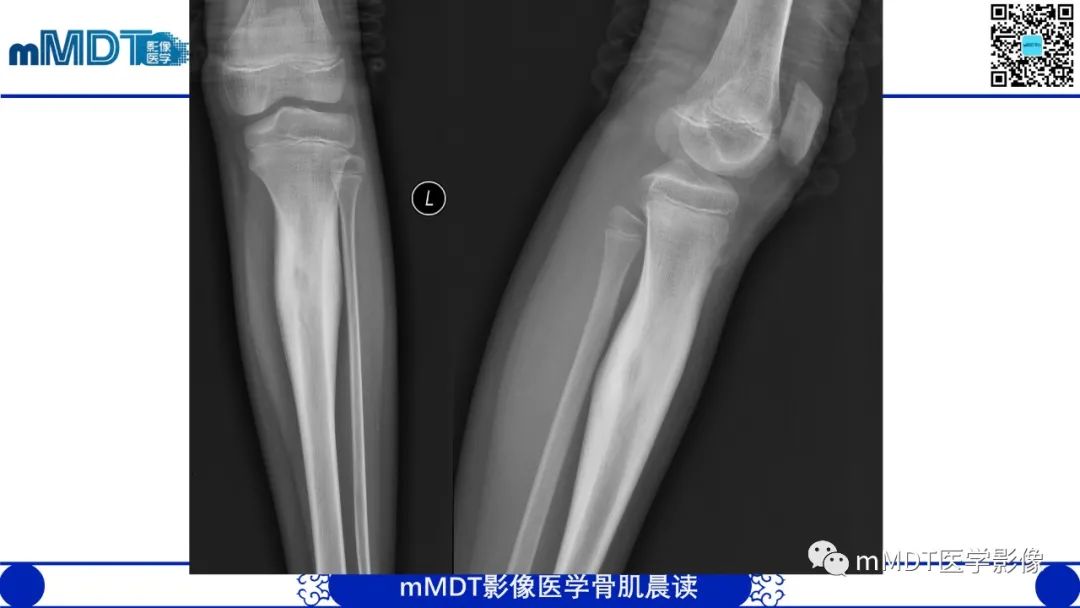 影像PPT - 【病例】典型骨样骨瘤1例X线CT及MR影像-4