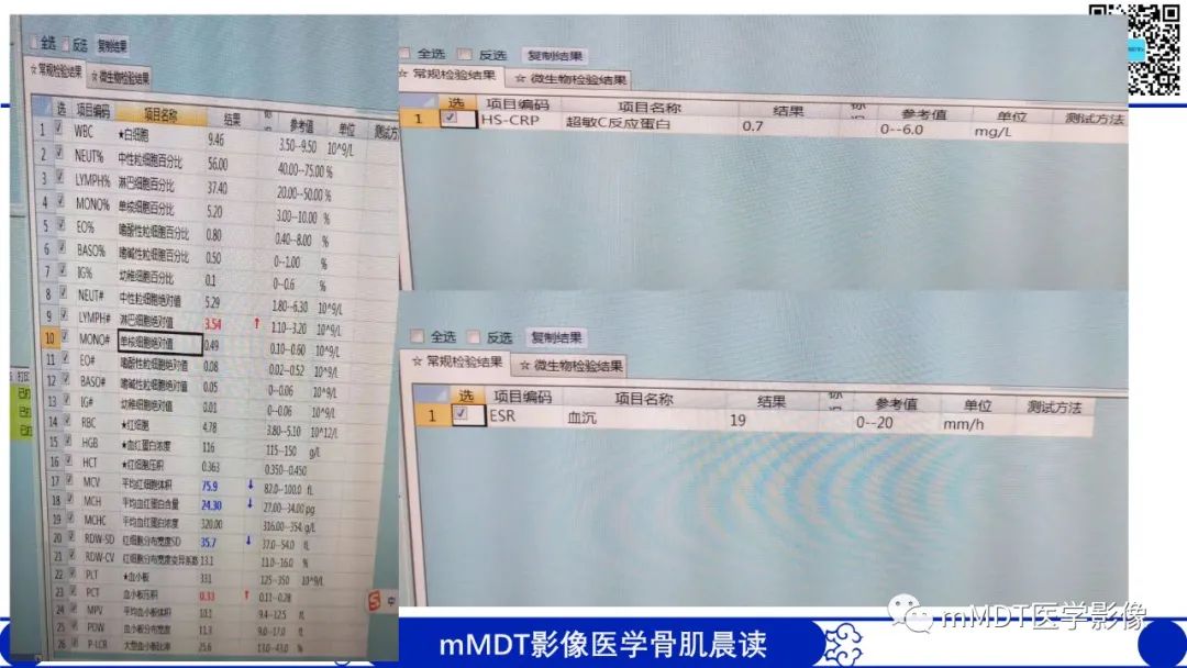 影像PPT - 【病例】典型骨样骨瘤1例X线CT及MR影像-3