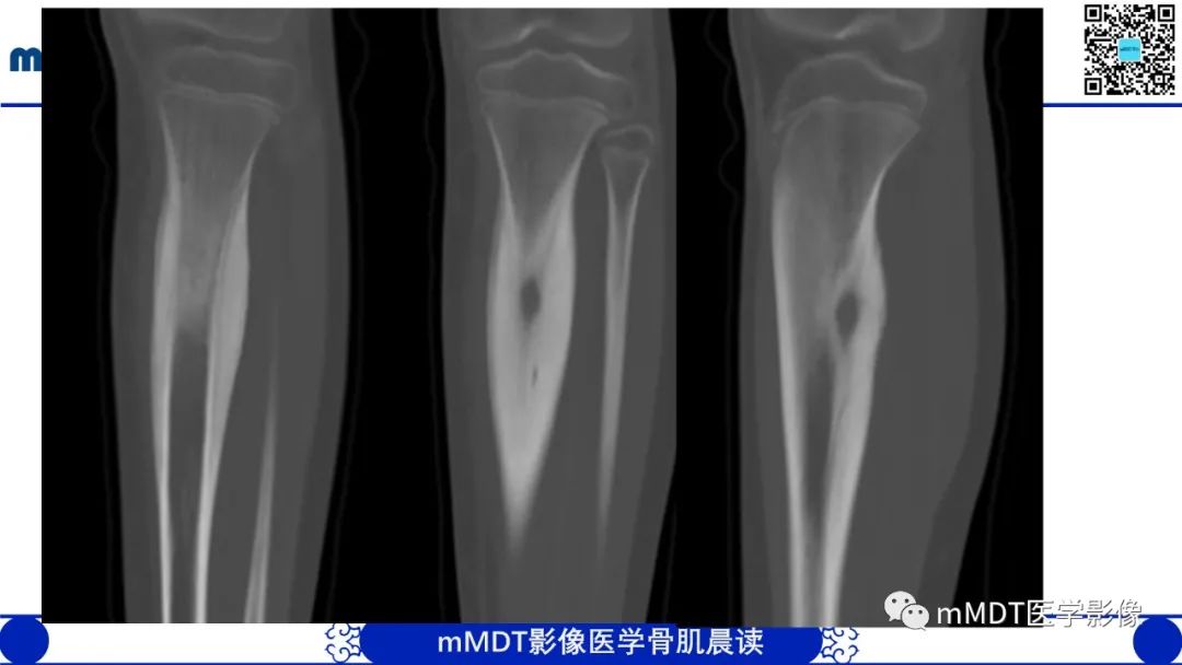 影像PPT - 【病例】典型骨样骨瘤1例X线CT及MR影像-6