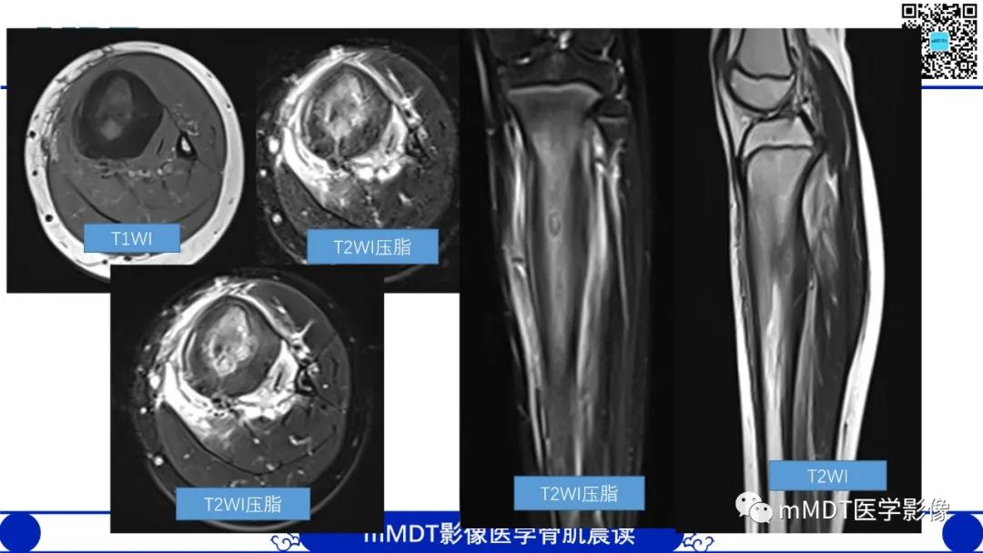 影像PPT - 【病例】典型骨样骨瘤1例X线CT及MR影像-7