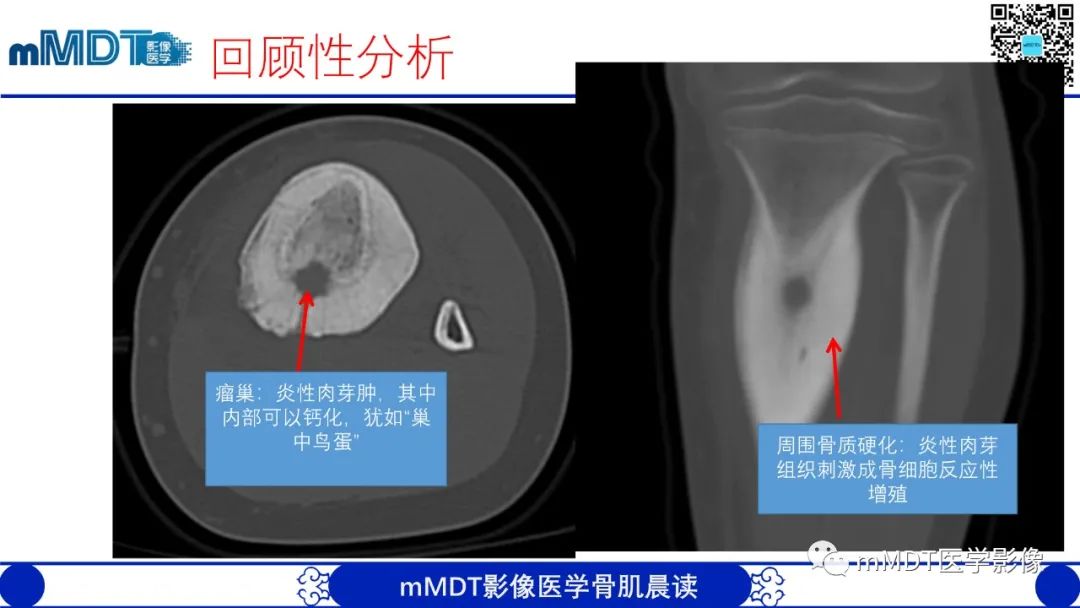 影像PPT - 【病例】典型骨样骨瘤1例X线CT及MR影像-14