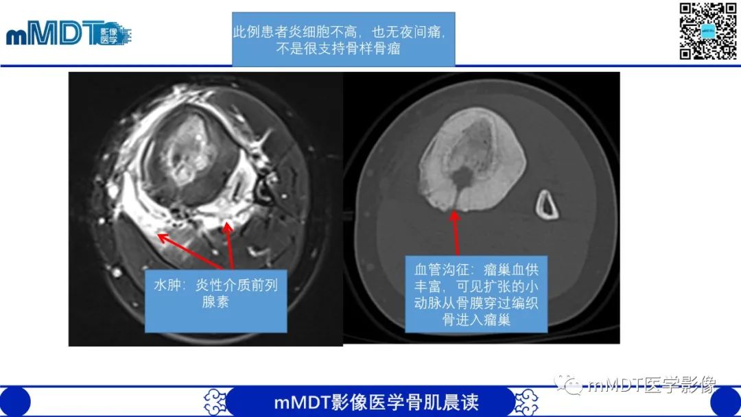 影像PPT - 【病例】典型骨样骨瘤1例X线CT及MR影像-15
