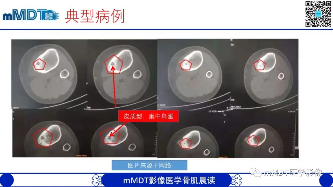 影像PPT - 【病例】典型骨样骨瘤1例X线CT及MR影像-16