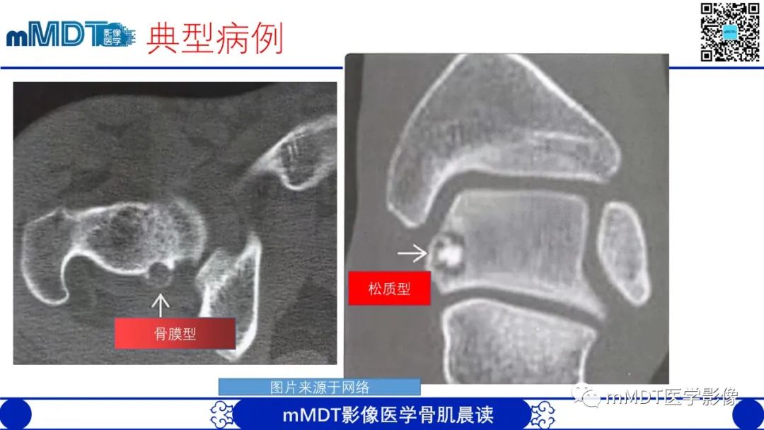 影像PPT - 【病例】典型骨样骨瘤1例X线CT及MR影像-17