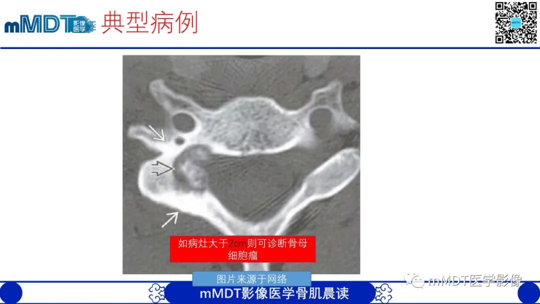 影像PPT - 【病例】典型骨样骨瘤1例X线CT及MR影像-19