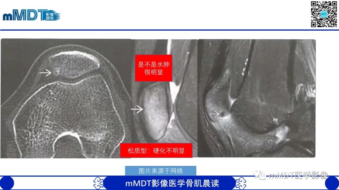 影像PPT - 【病例】典型骨样骨瘤1例X线CT及MR影像-18