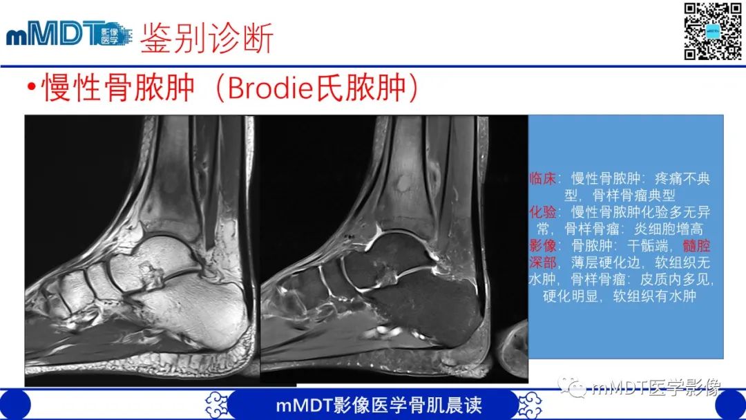 影像PPT - 【病例】典型骨样骨瘤1例X线CT及MR影像-20