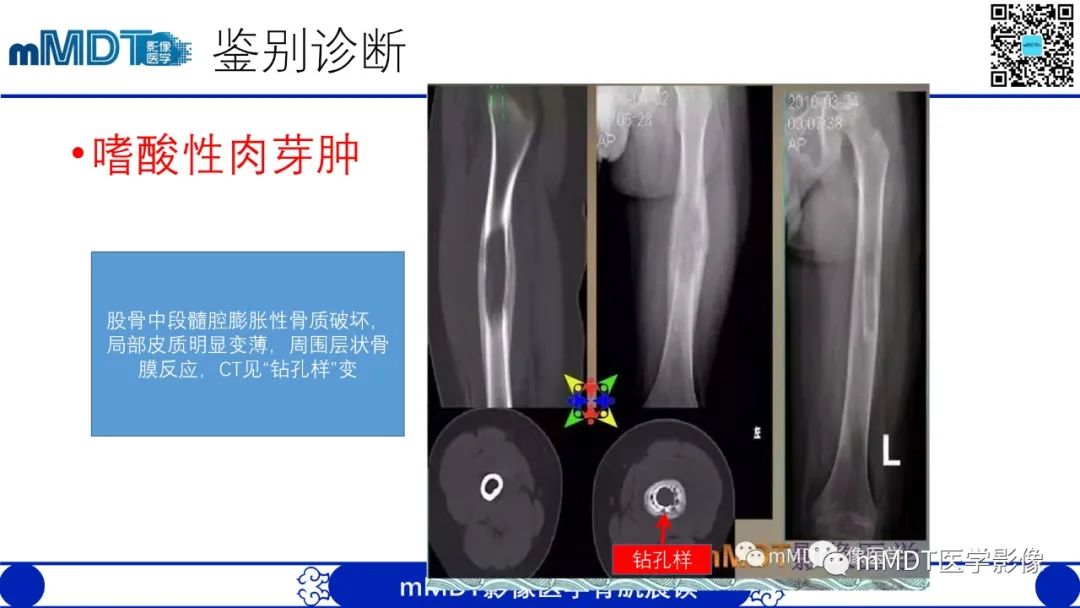 影像PPT - 【病例】典型骨样骨瘤1例X线CT及MR影像-21