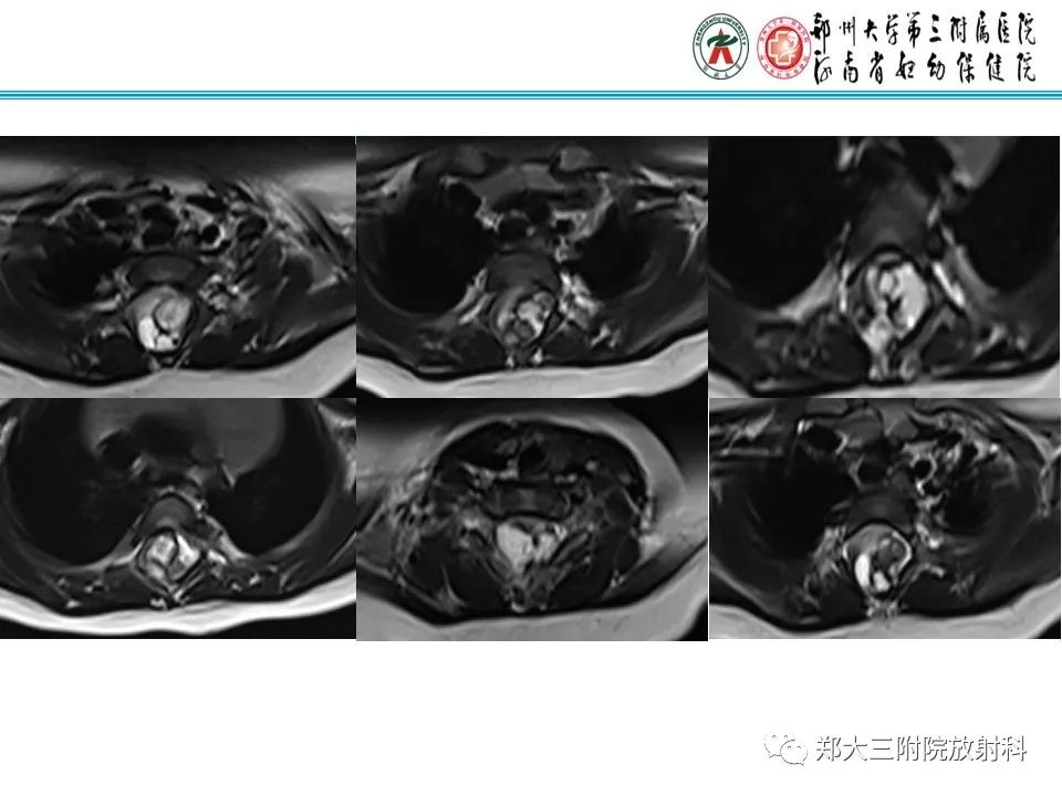 影像PPT - 【PPT】皮样囊肿与表皮样囊肿的鉴别-7