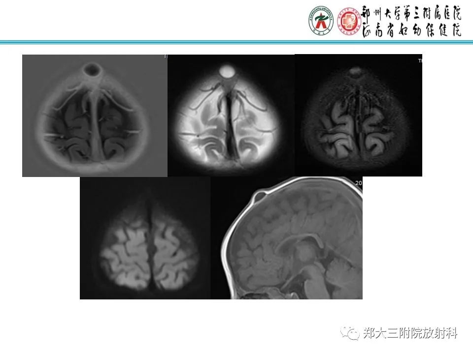 影像PPT - 【PPT】皮样囊肿与表皮样囊肿的鉴别-15