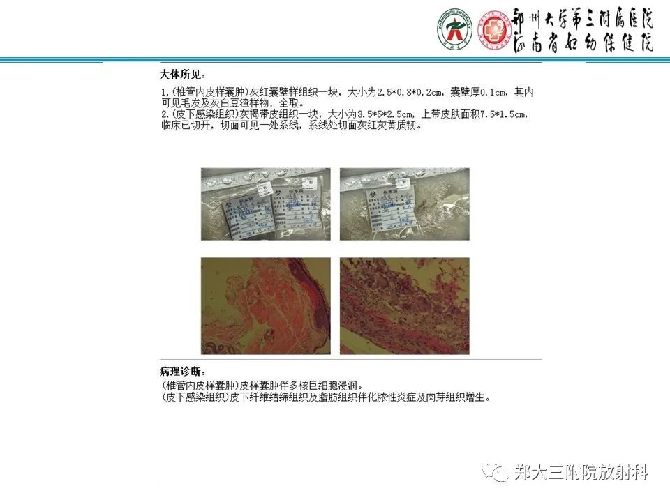 影像PPT - 【PPT】皮样囊肿与表皮样囊肿的鉴别-13