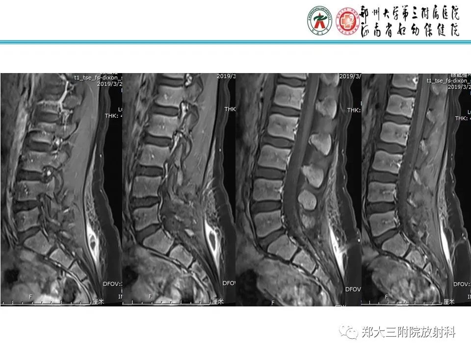 影像PPT - 【PPT】皮样囊肿与表皮样囊肿的鉴别-12