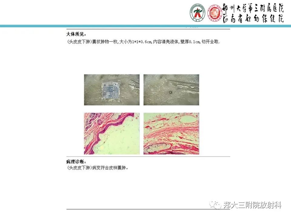 影像PPT - 【PPT】皮样囊肿与表皮样囊肿的鉴别-16