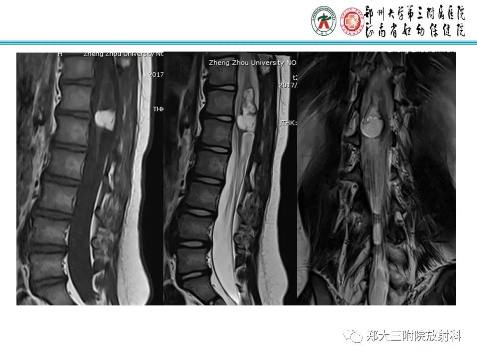 影像PPT - 【PPT】皮样囊肿与表皮样囊肿的鉴别-24