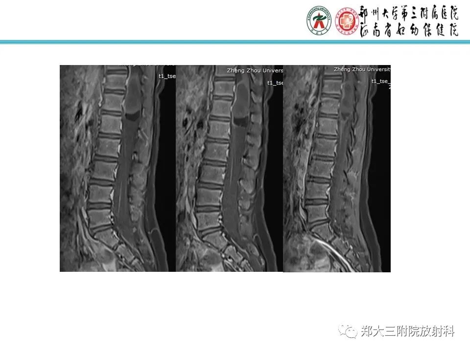影像PPT - 【PPT】皮样囊肿与表皮样囊肿的鉴别-25