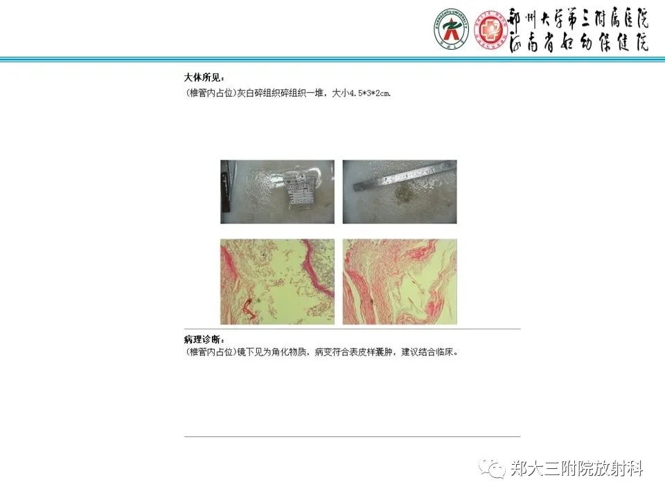 影像PPT - 【PPT】皮样囊肿与表皮样囊肿的鉴别-26