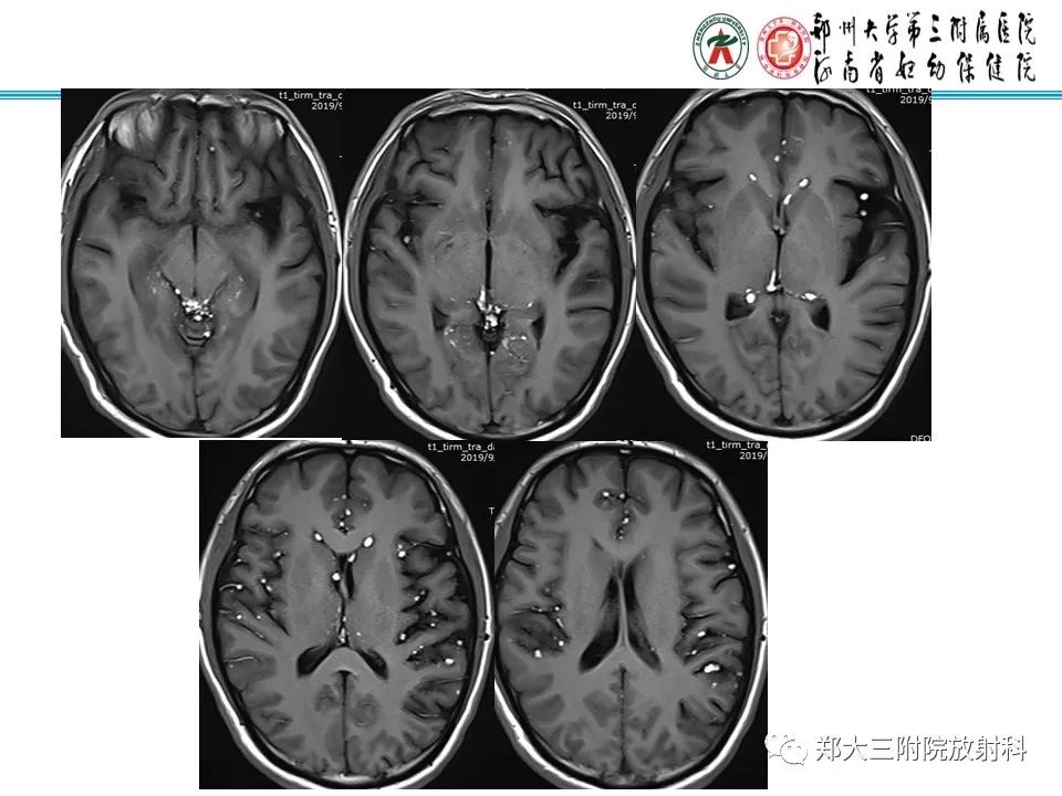 影像PPT - 【PPT】皮样囊肿与表皮样囊肿的鉴别-30