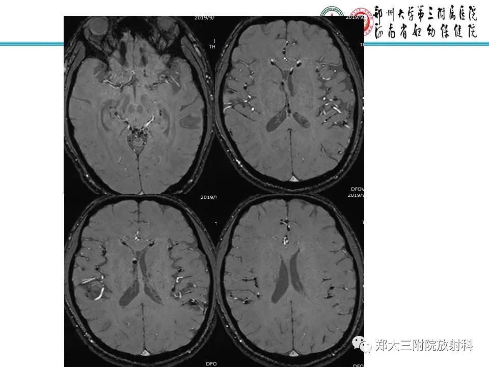 影像PPT - 【PPT】皮样囊肿与表皮样囊肿的鉴别-32