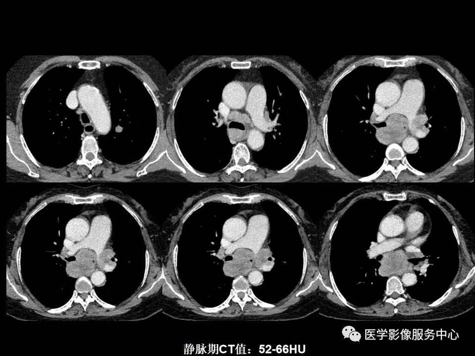 影像PPT - 【病例】中央型小细胞肺癌的CT与病理分析-2
